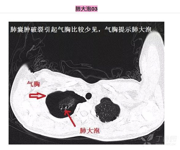 右肺尖肺大泡图片