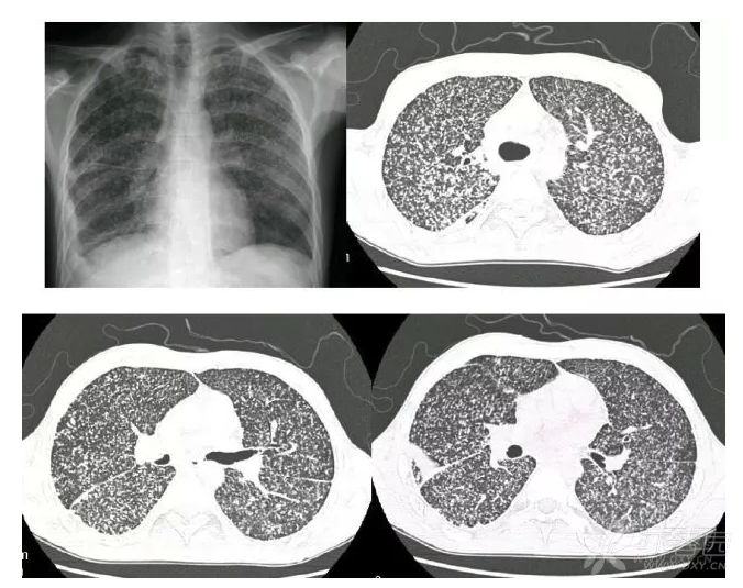 周围型肺癌:病灶最大径>30 mm,右肺上叶后段可见一肿块,边缘分叶.