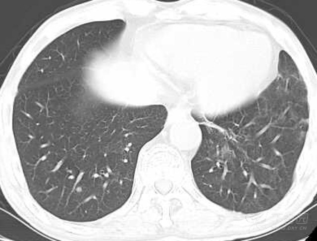 肺癌病人口苦是怎么回事_肺癌ct图片