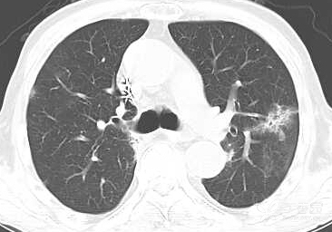 肺癌病人口苦是怎么回事_肺癌ct图片