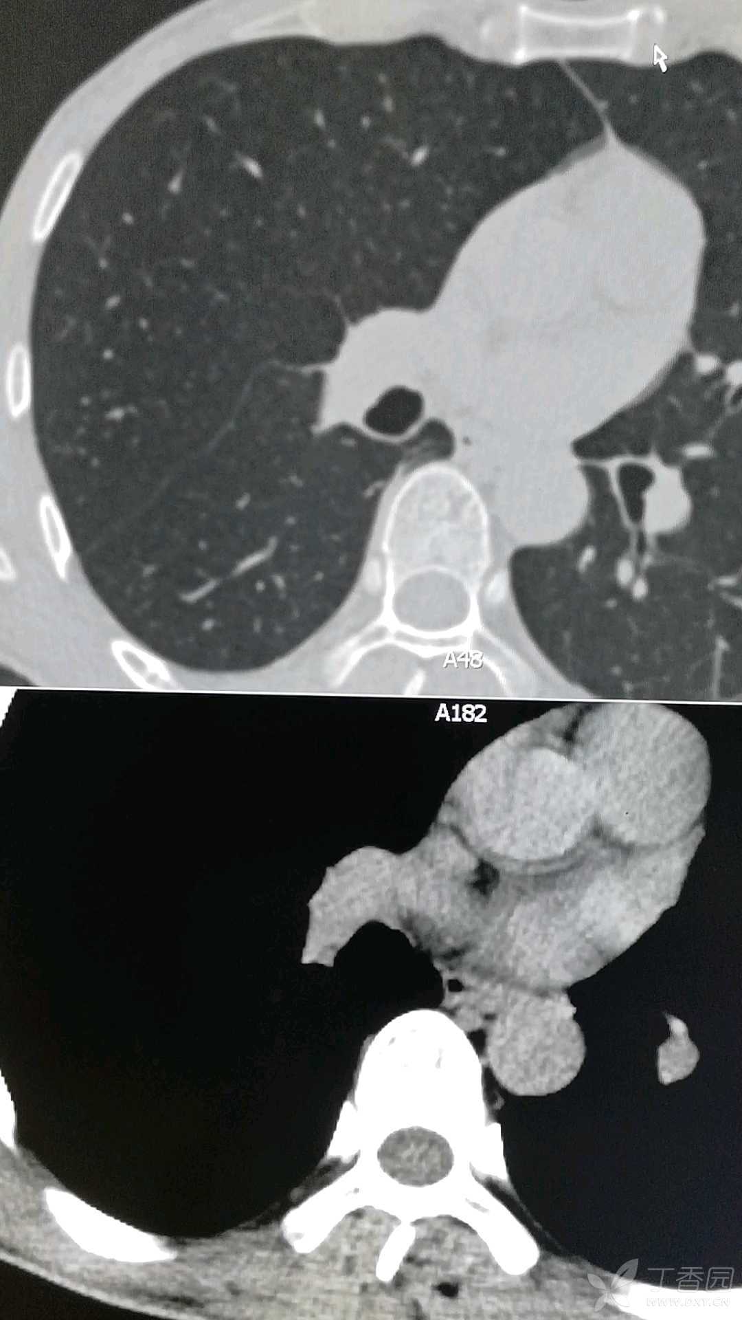 肺部粘液栓图片
