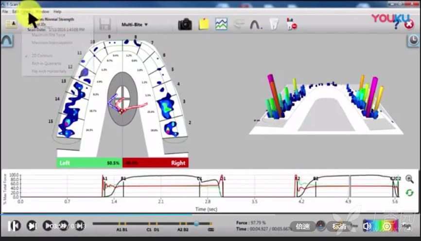 口腔咬合重建,口腔咬合修复工具--美国t-scan novus数字咬合分析工具
