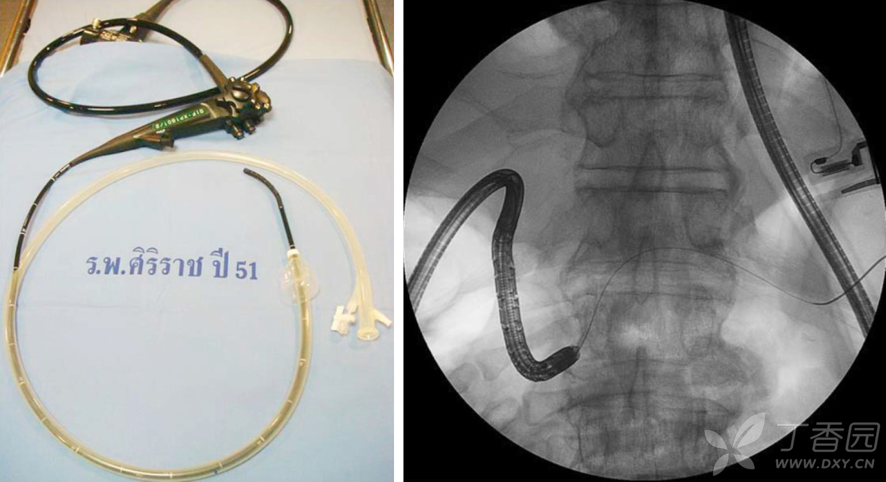 图4  超细胃镜在5fr气囊导管辅助下进入胰管.