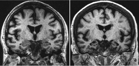 痴呆神经影像改变一 皮质萎缩之 阿尔茨海默病ad