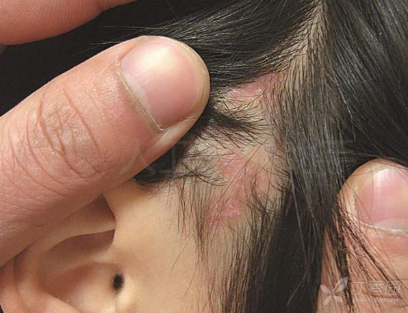 皮肤乳头状汗管囊腺瘤 - 丁香园论坛