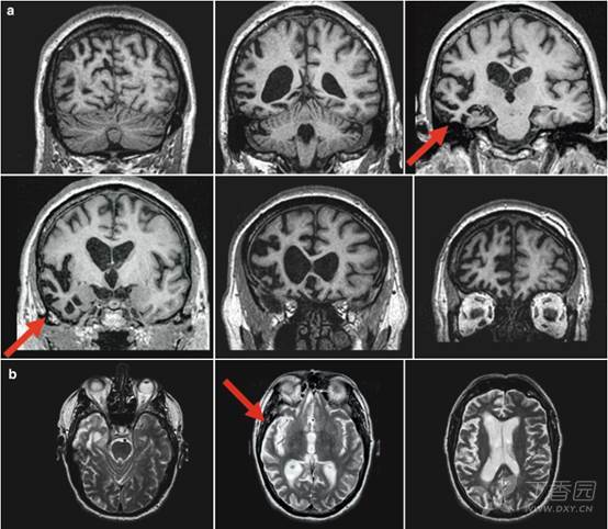 痴呆神經影像改變二 皮質萎縮之 額顳葉痴呆ftd