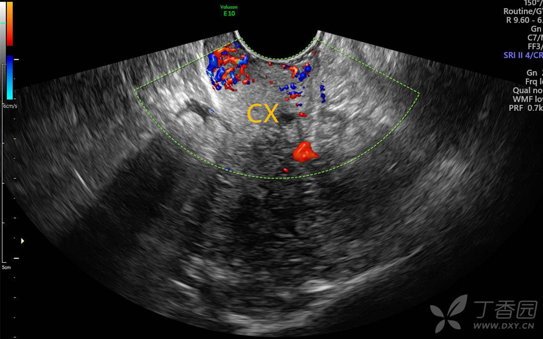 【妇科】宫颈的一团"火"(公布病理) - 超声医学讨论版 - 专业医生社区