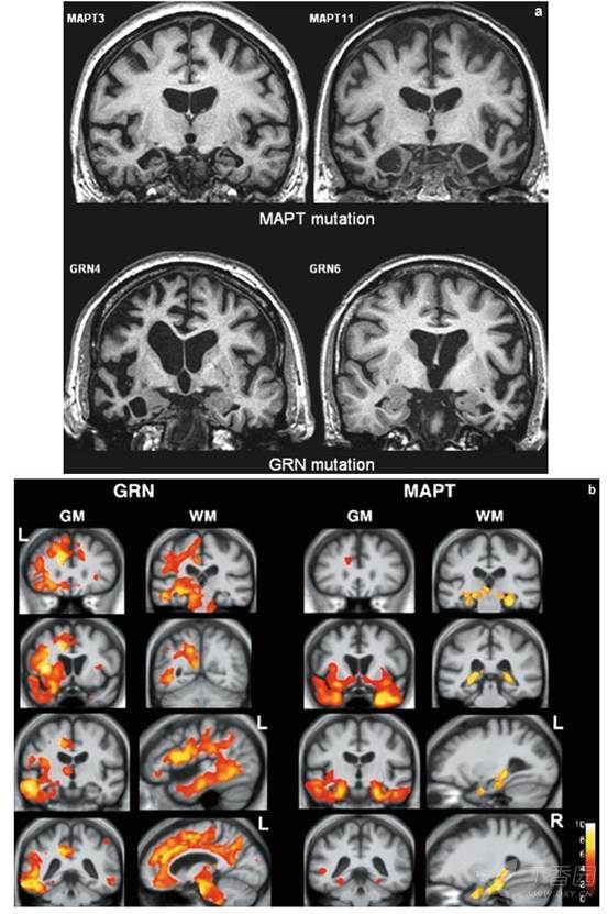 痴呆神经影像改变二 皮质萎缩之 额颞叶痴呆ftd