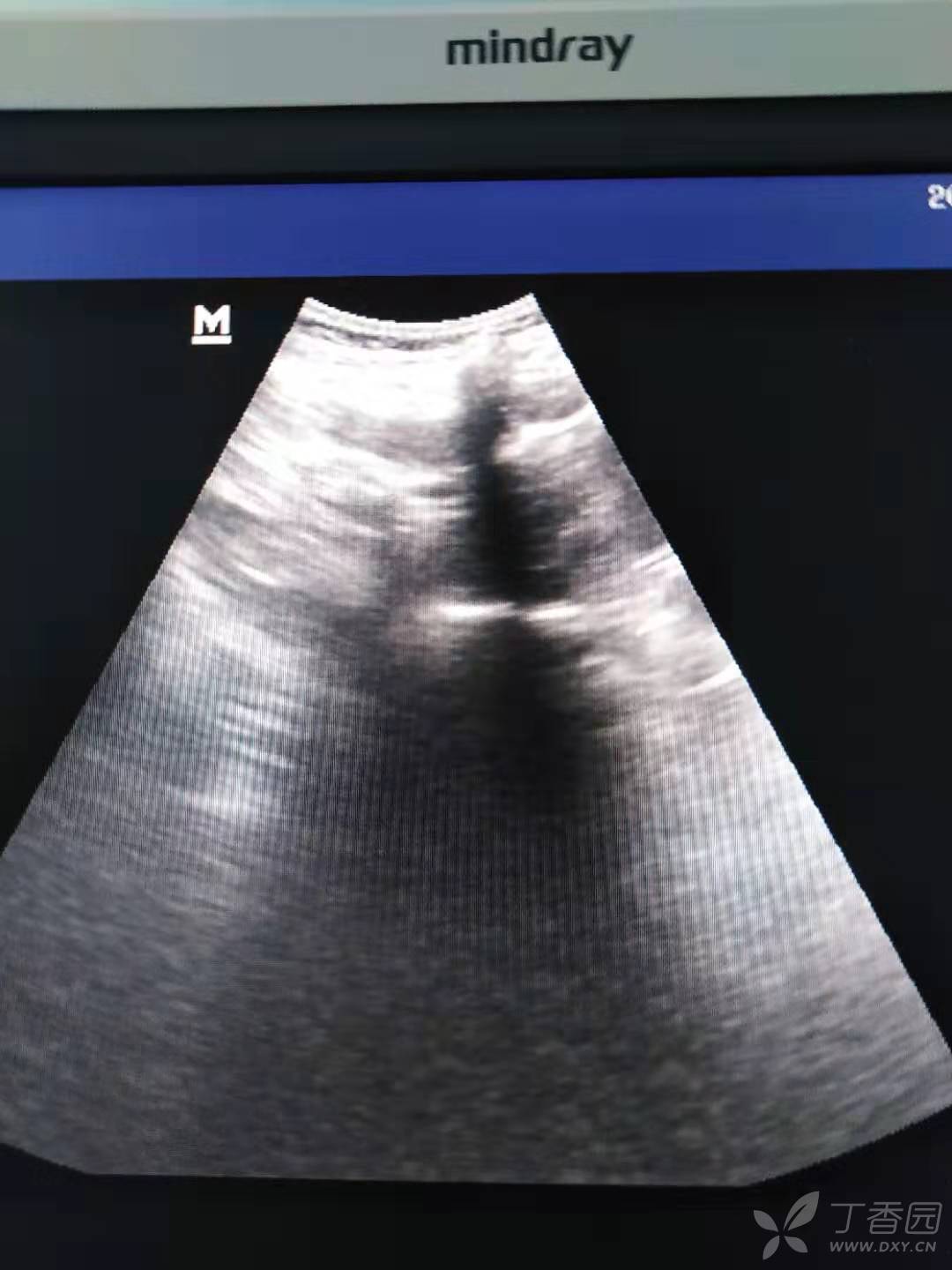 超声下腰丛神经阻滞的解剖要点