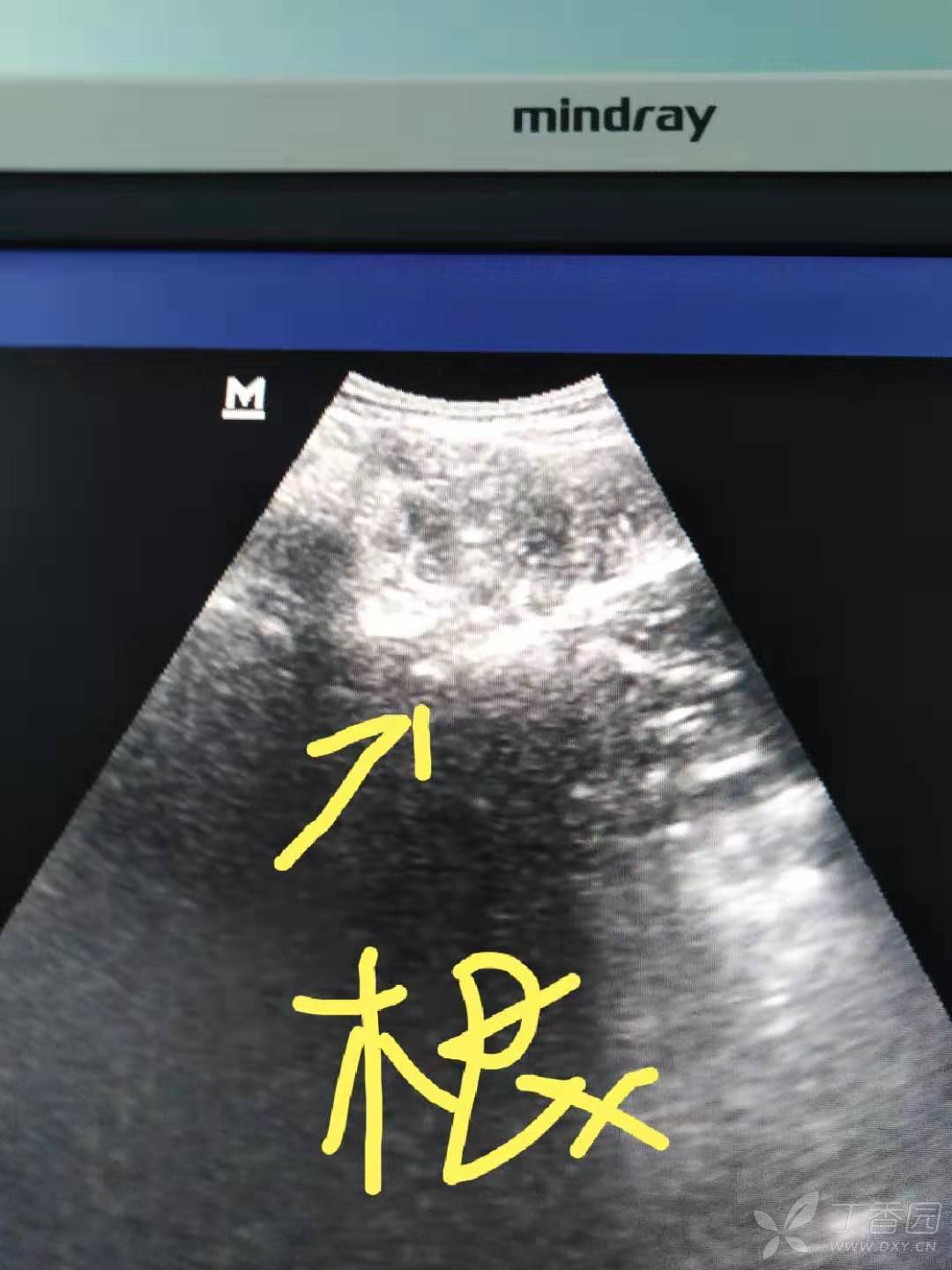 后路横突及三叶草样图像(腰大肌,腰方肌,竖脊肌)