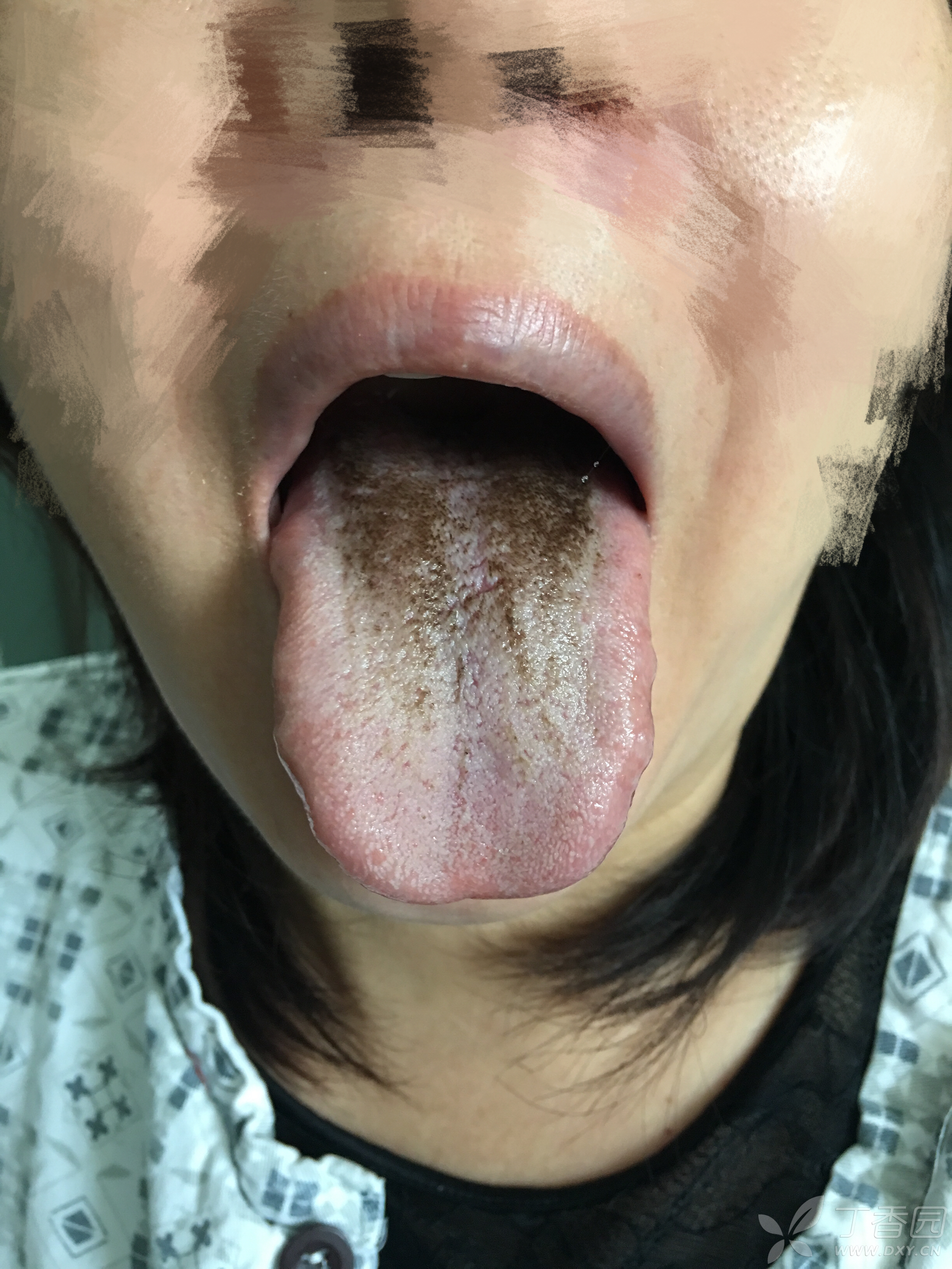 无痛肠镜检查后舌苔变黑,请教大家是什么导致的?
