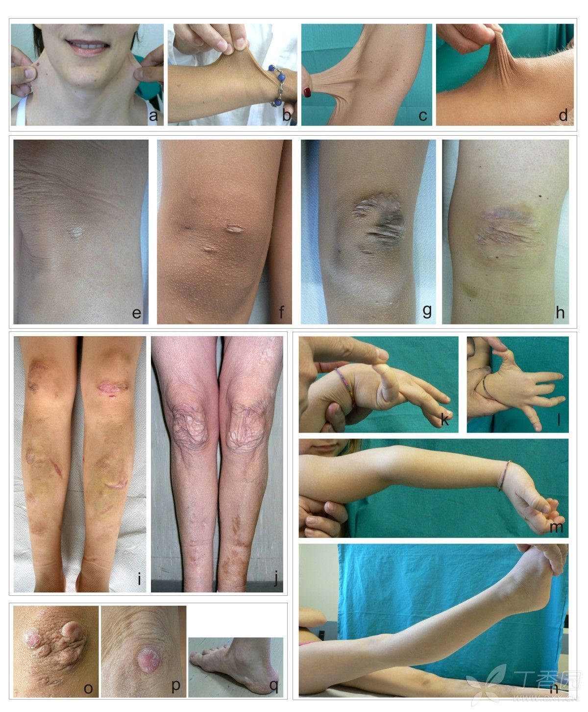 男性青年,30岁,体态匀称,全身多发,表皮松懈,缺乏弹性,这是什么病?