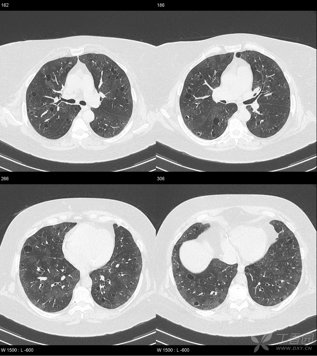 看圖識病第40期:肺部瀰漫囊性病變4例,歡迎挑戰! [病例帖]