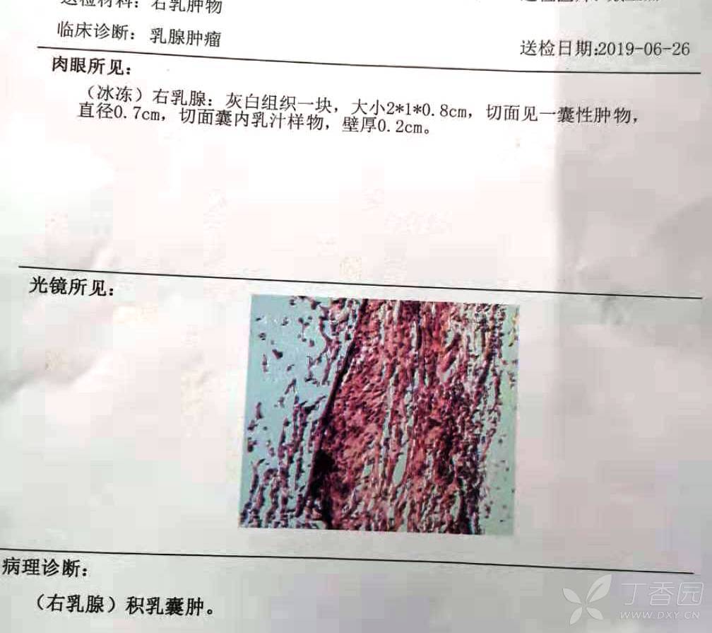 乳腺结节化脓 乳腺微创麻醉伤口图片