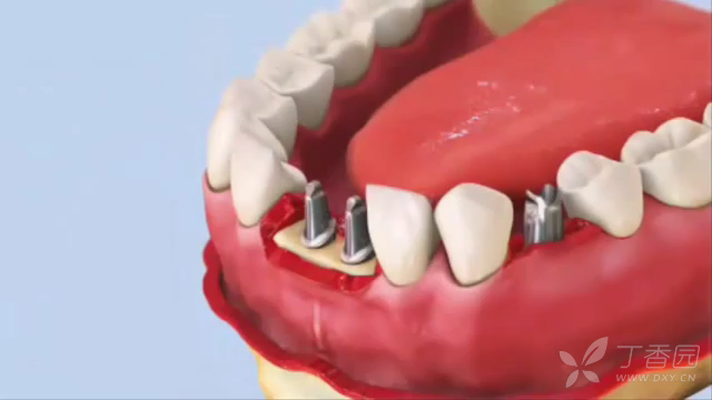 牙齿种植过程