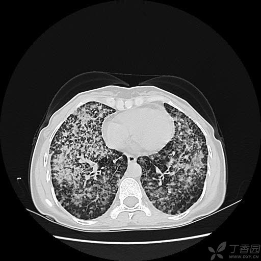 女性39岁 两肺弥漫性病变 [病例帖]