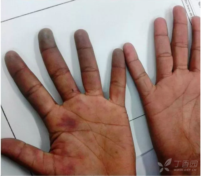 行医笔记:皮肤损害的五彩缤纷