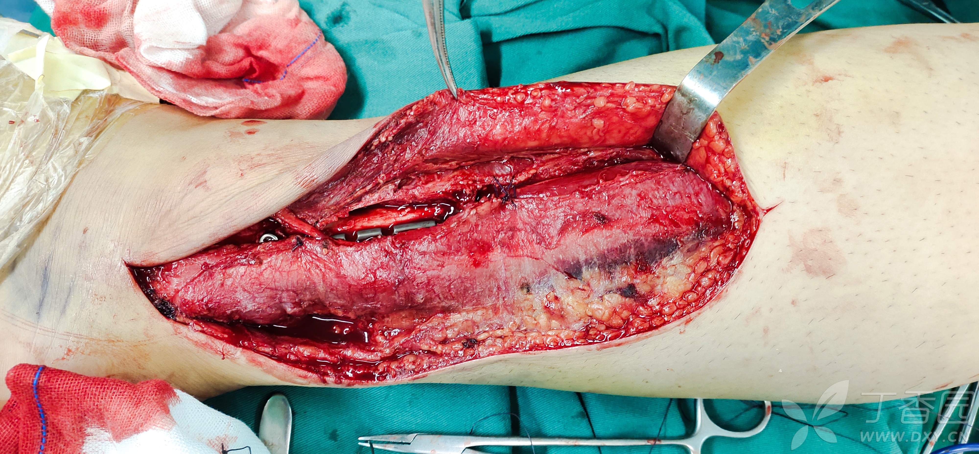 腓浅神经变异一例 - 丁香园论坛