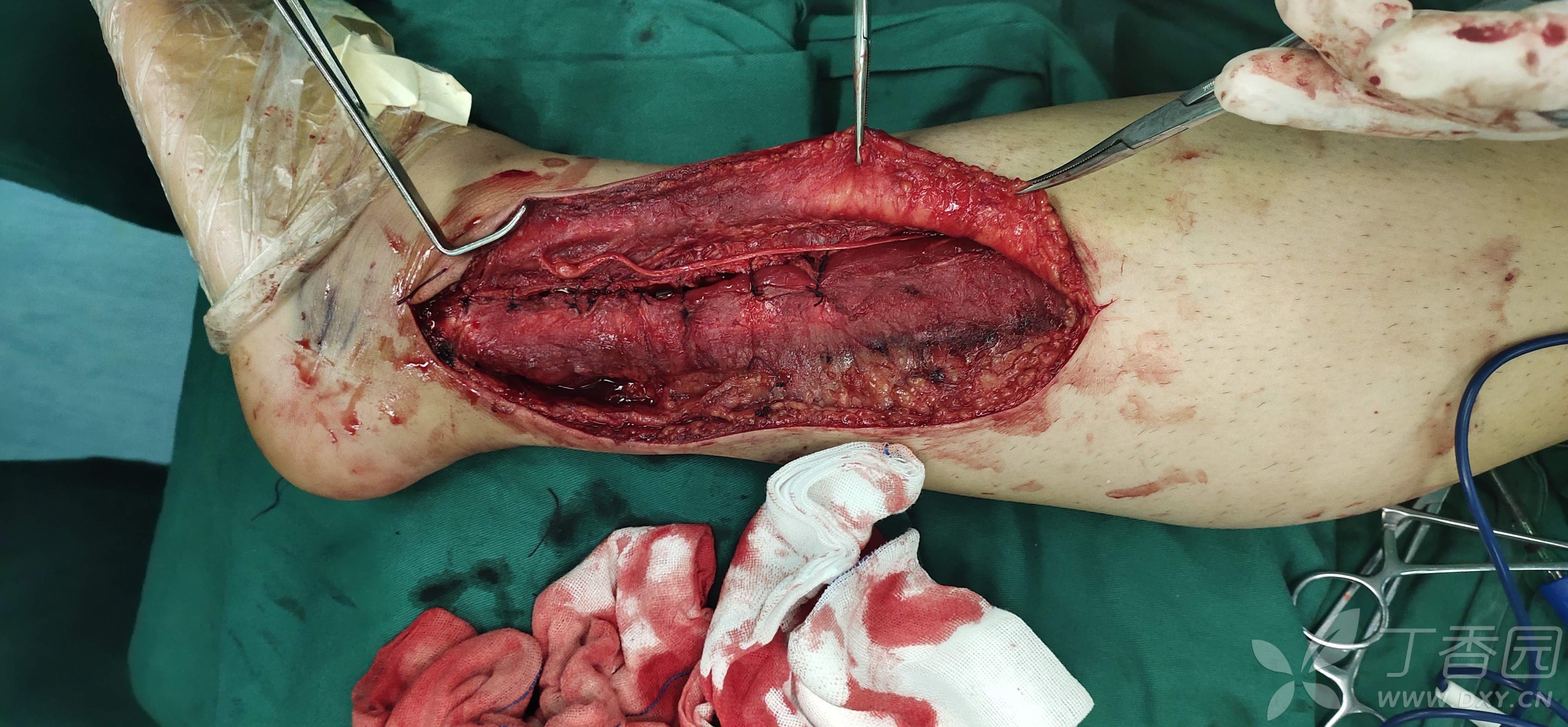 腓浅神经变异一例 - 丁香园论坛