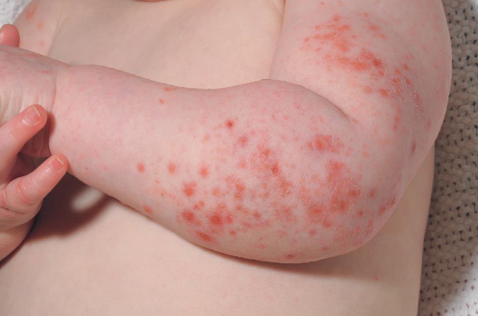 小儿湿疹图片初期症状图片