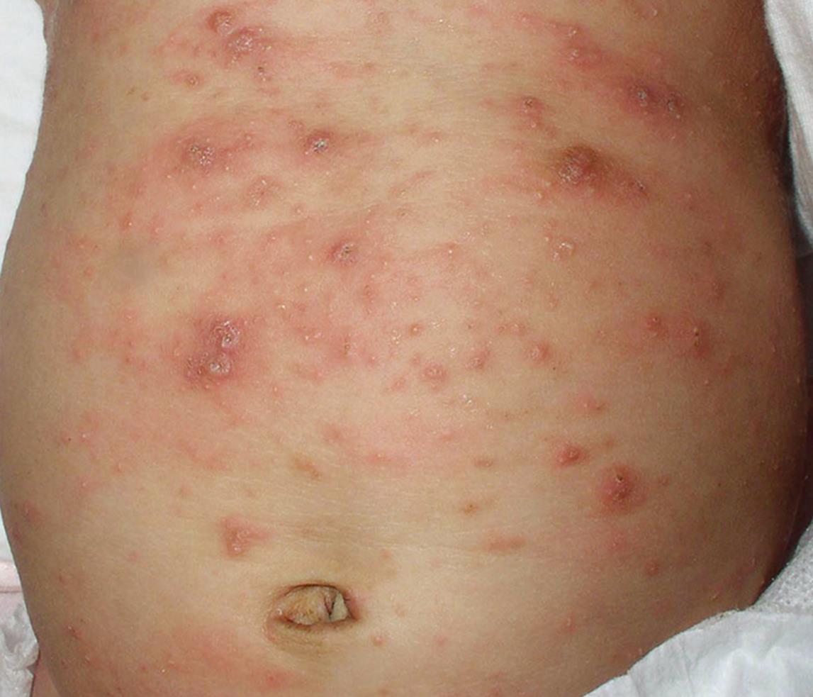 14种湿疹和皮炎类的儿童皮肤病图片及临床特征和鉴别诊断 [病例帖]