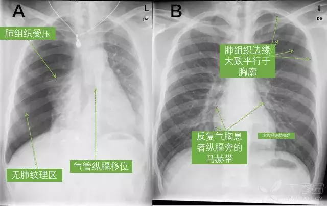 肺炎胸片图解解读图片