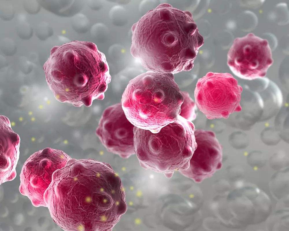 nk-92mi 人恶性非霍奇金淋巴瘤患者的自然杀伤细胞