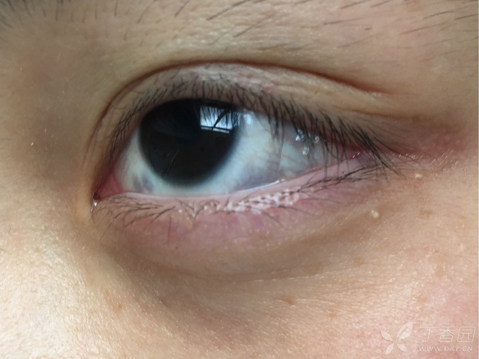 【讨论】褐青斑 太田痣合并发生一例?