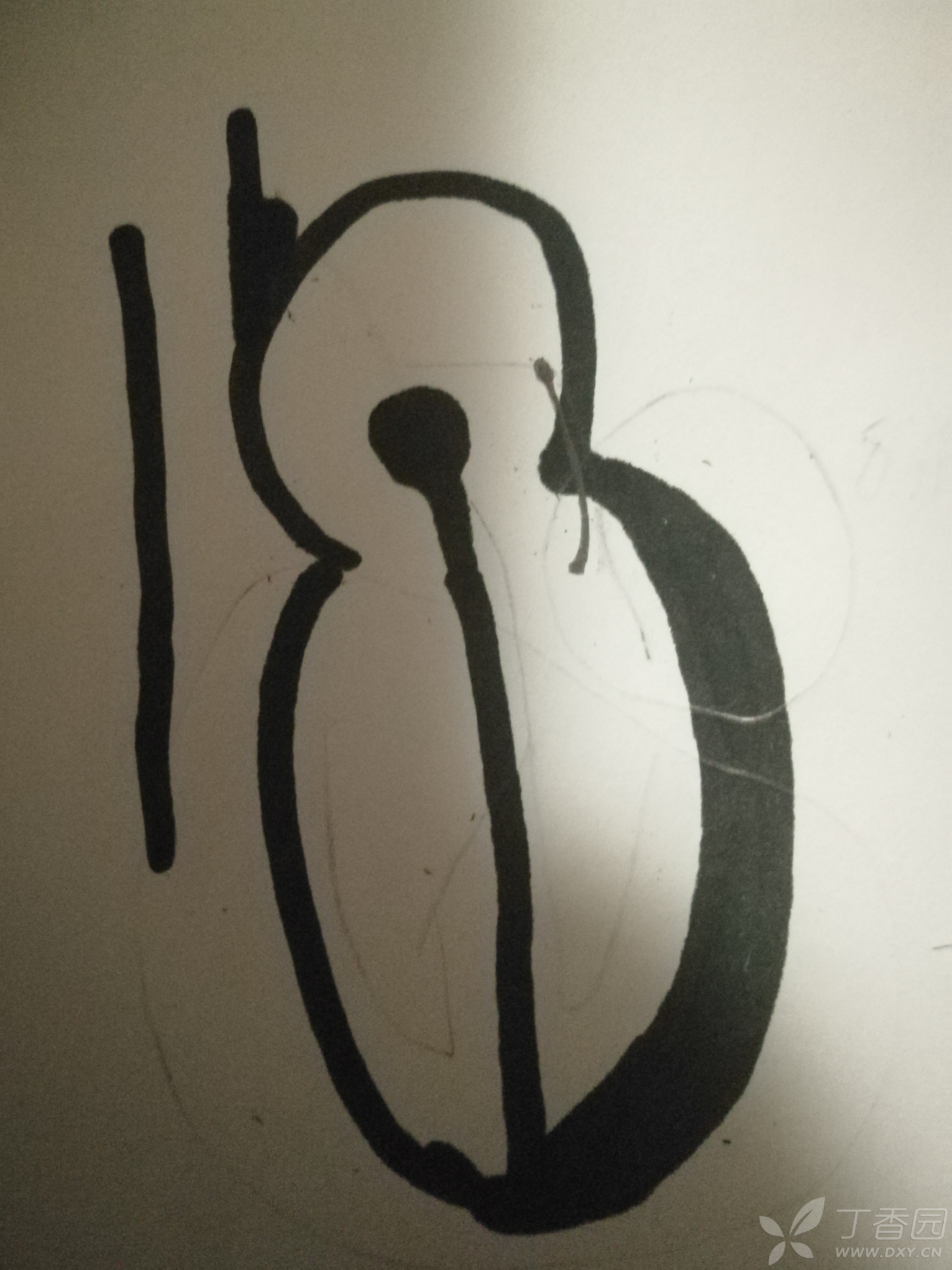 复习lgl综合征 - 急救与危重病讨论版 -丁香园论坛