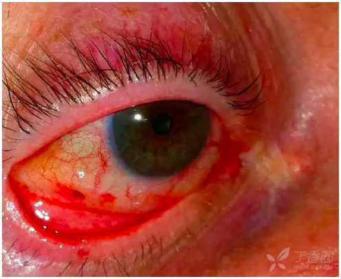 osler 结节和 janeway 损害的鉴别诊断包括血管炎,抗磷脂抗体综合征