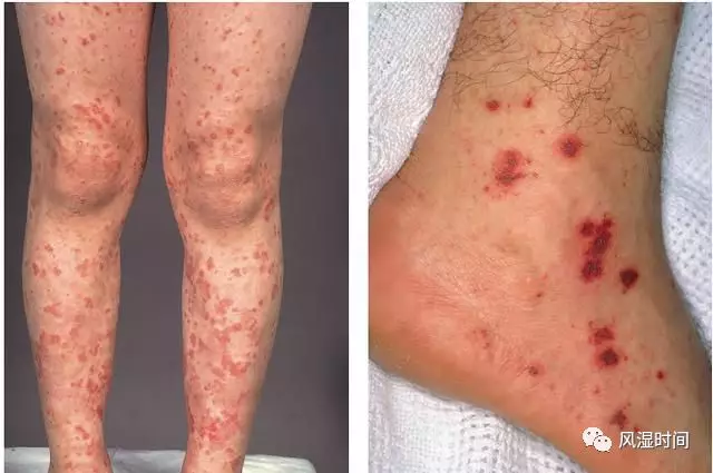 过敏性紫癜 如何诊断才对