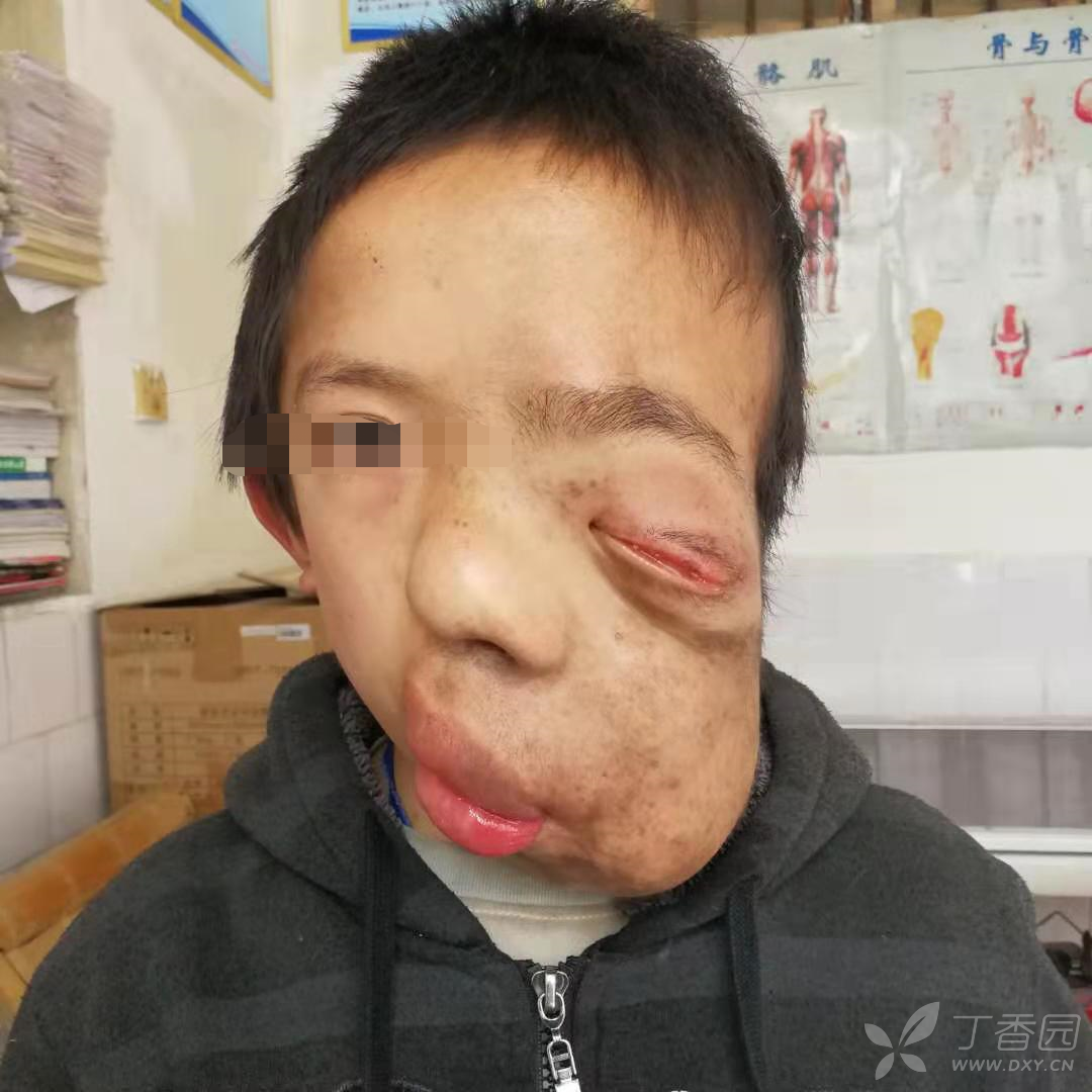为贫困山区的"象面人"儿童求助! [病例帖]