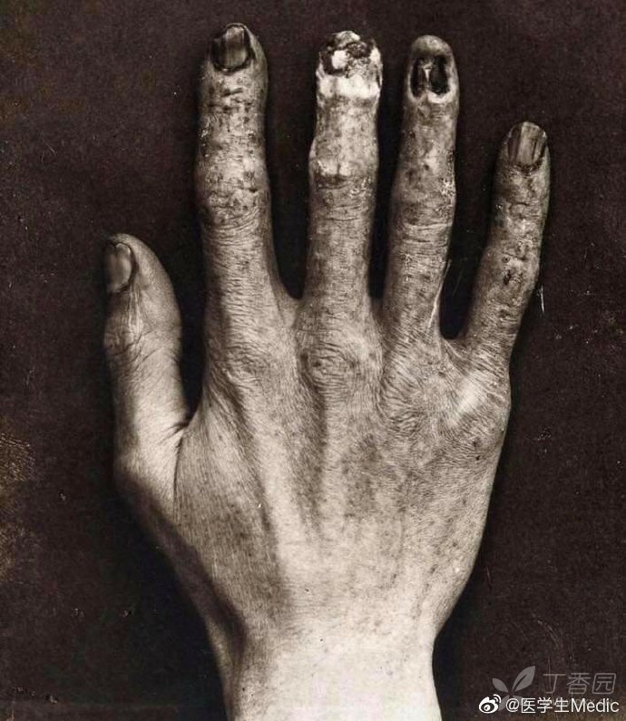 x 射线技术人员显示辐射损伤的手,约1900年