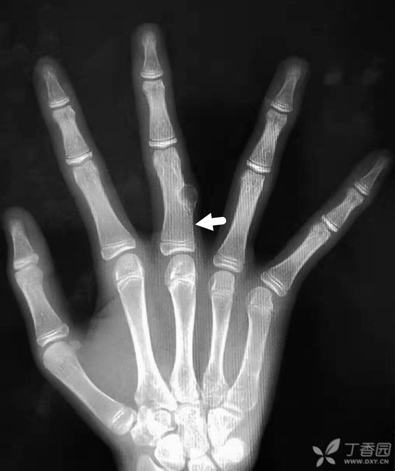 右手中指近节指骨中段尺侧骨皮质可见一膨胀性骨质破坏,病灶内