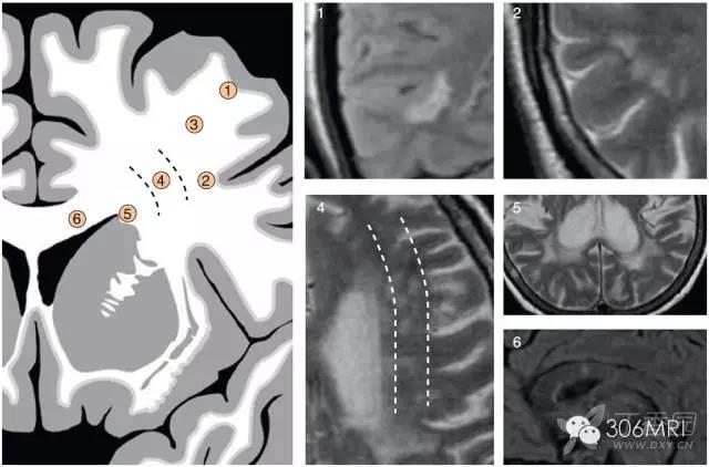脑白质区内mri斑点状异常信号解读