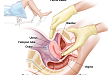 SOGC 解读 | 妇科检查的适应症