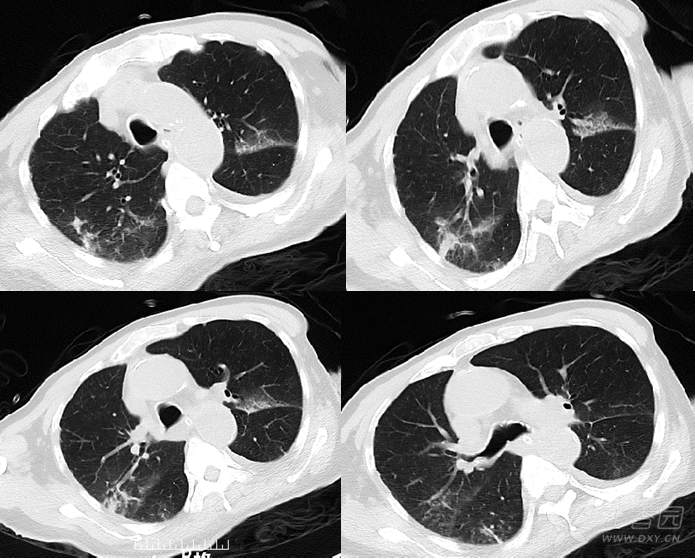 『专题讨论』坠积性肺炎,做气管镜灌洗有用吗?