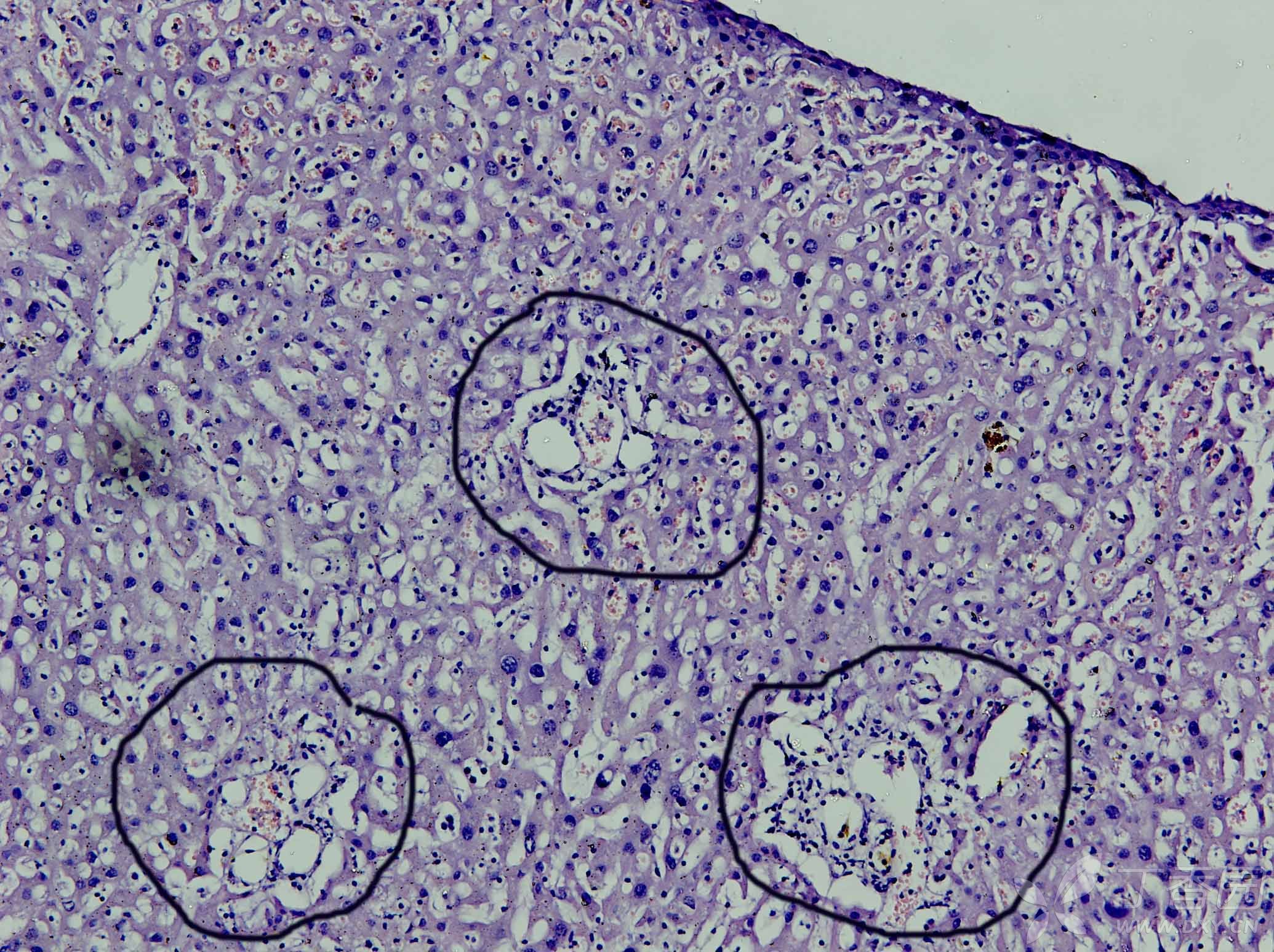 肝细胞水肿镜下图片图片