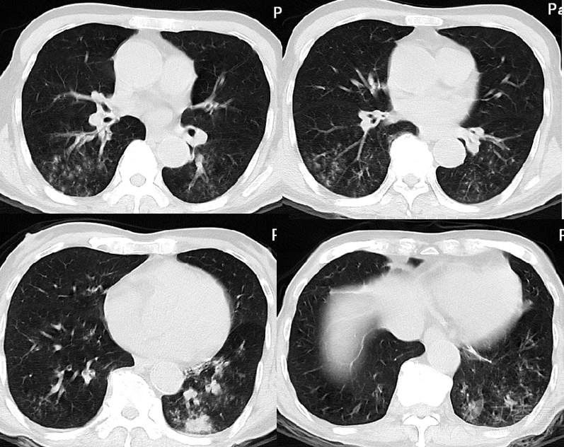 『专题讨论』坠积性肺炎,做气管镜灌洗有用吗?