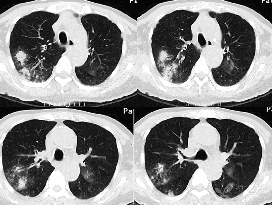 『专题讨论』坠积性肺炎,做气管镜灌洗有用吗?