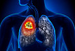 NSCLC 治疗格局如何来看？董晓荣教授为你答疑解惑