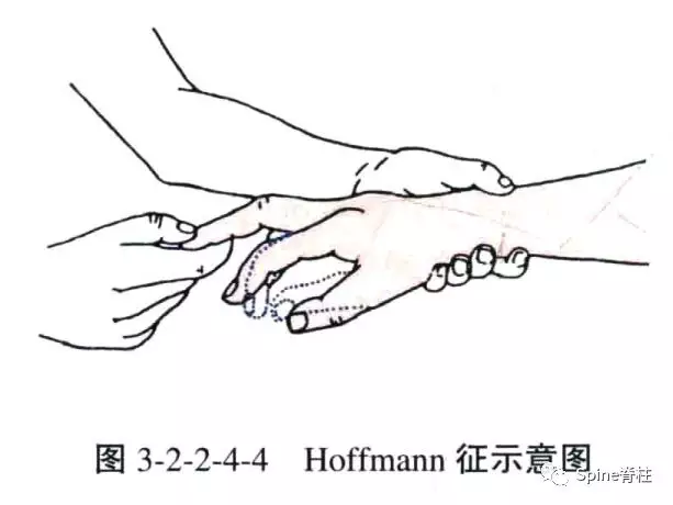 通过必应国际版搜索 hoffmann 征图片,可以看到各种不同的做法.