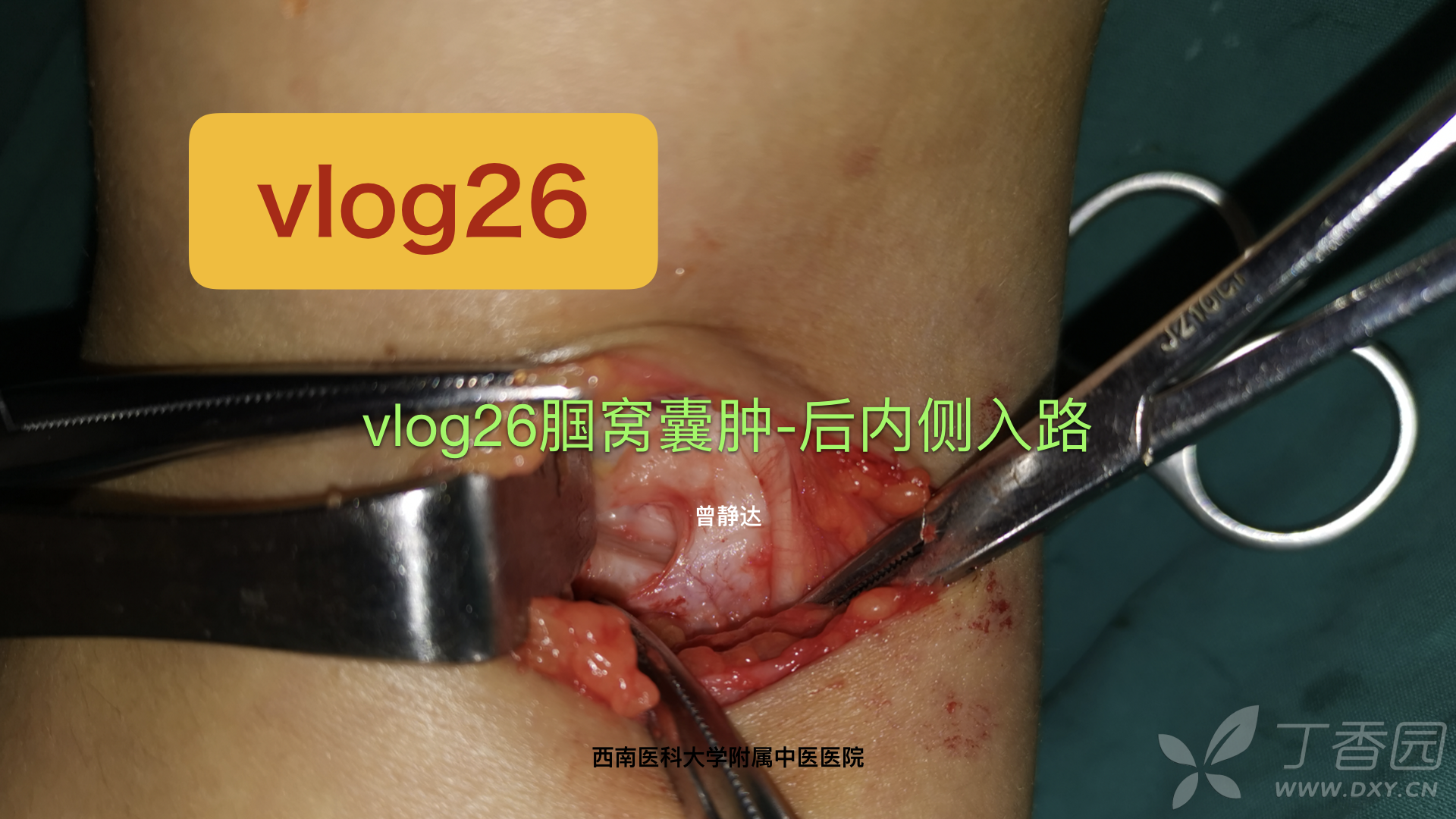 讲座vlog26腘窝囊肿后内侧入路手术字幕解说
