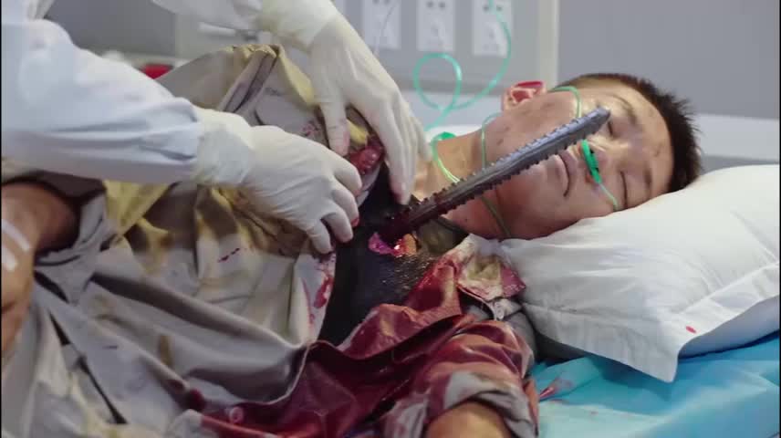 被钢筋刺穿肺的患者,手术全过程的影视展示,你怎么看待? - 丁香园论坛