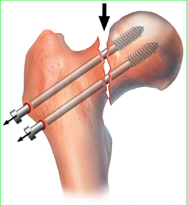 股骨颈骨折打钉示意图图片
