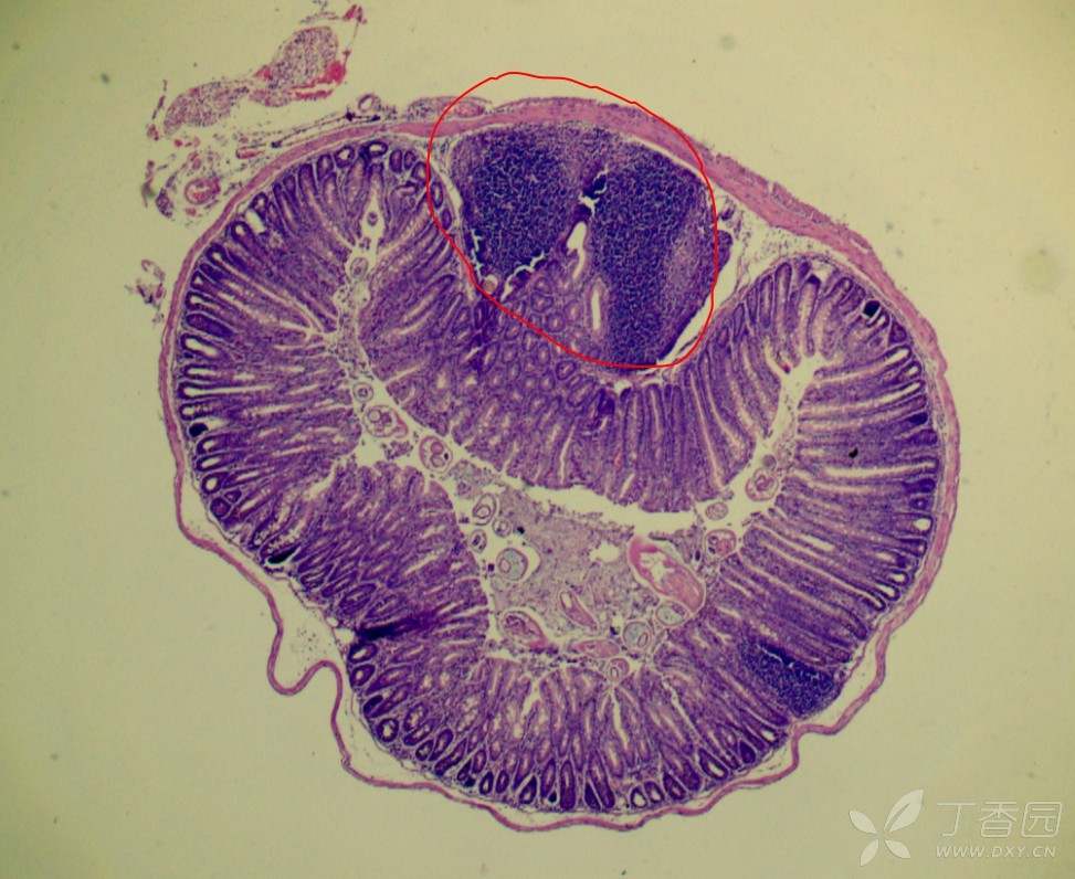 小肠病理切片图片