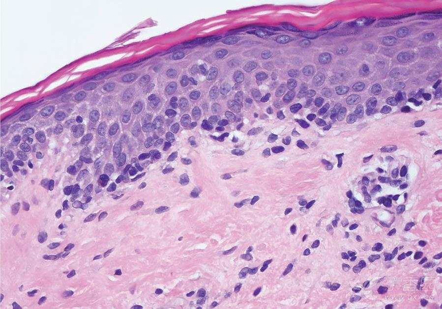 5年轻度瘙痒皮肤异色斑片和稀薄斑块,请你来分析