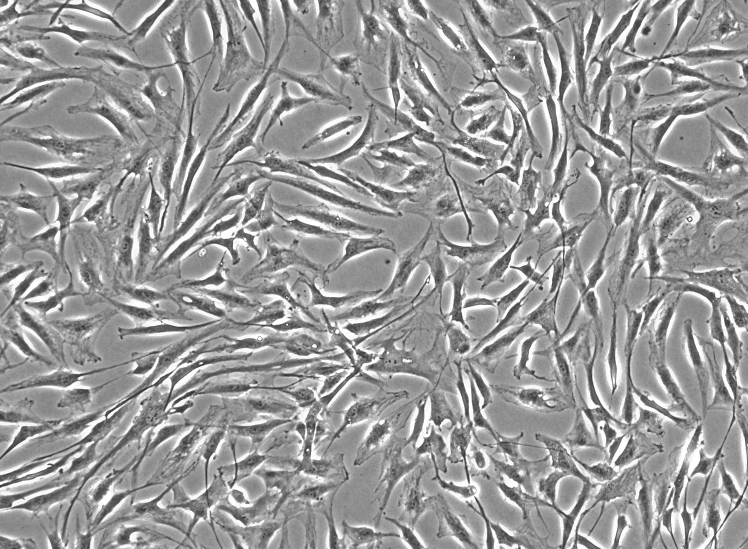人急性淋巴母细胞性白血病细胞