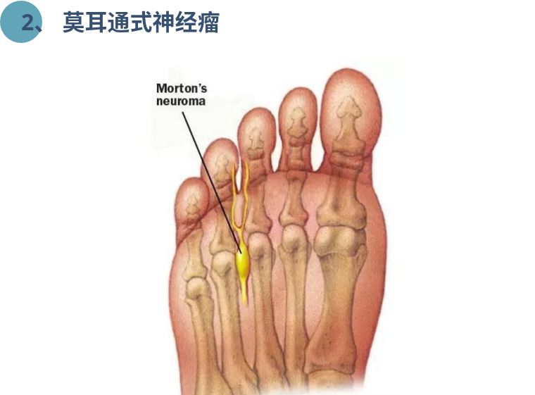 钳夹型(pincer type):常见于髋臼内陷,髋臼后倾等