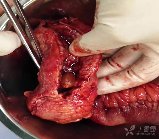腹腔结核图片